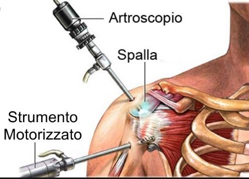 artroscopia spalla